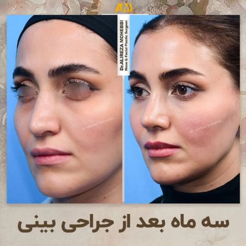 Rhinoplasty-50