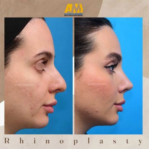 Rhinoplasty-55