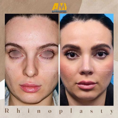Rhinoplasty-56