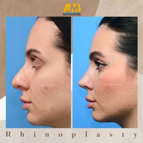 Rhinoplasty-57