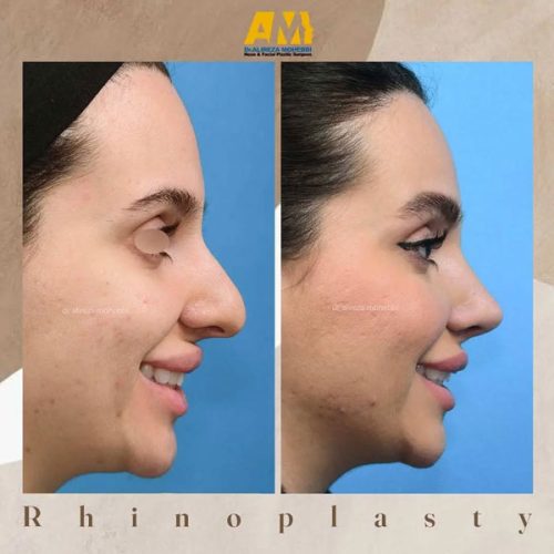 Rhinoplasty-58