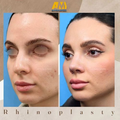 Rhinoplasty-60