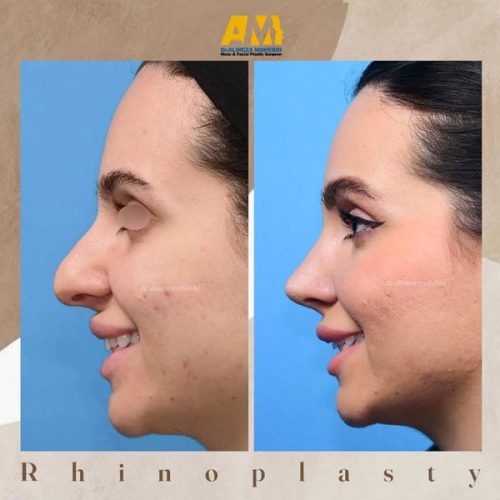 Rhinoplasty-61