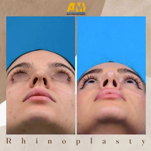 Rhinoplasty-62