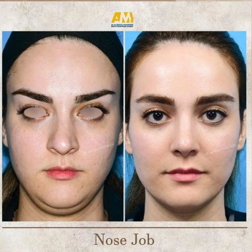 Rhinoplasty-63