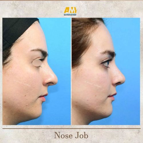 Rhinoplasty-64