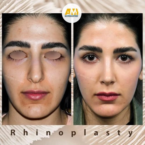 Rhinoplasty-67