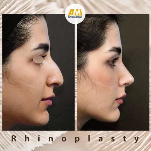 Rhinoplasty-68