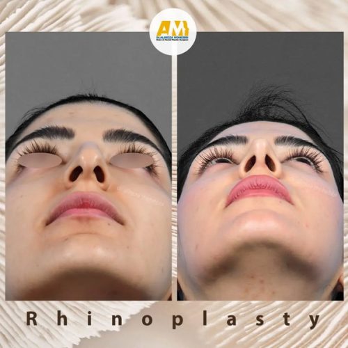 Rhinoplasty-69
