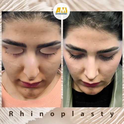 Rhinoplasty-70