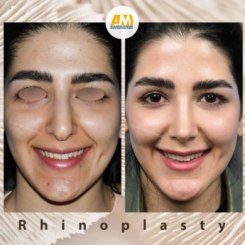 Rhinoplasty-71