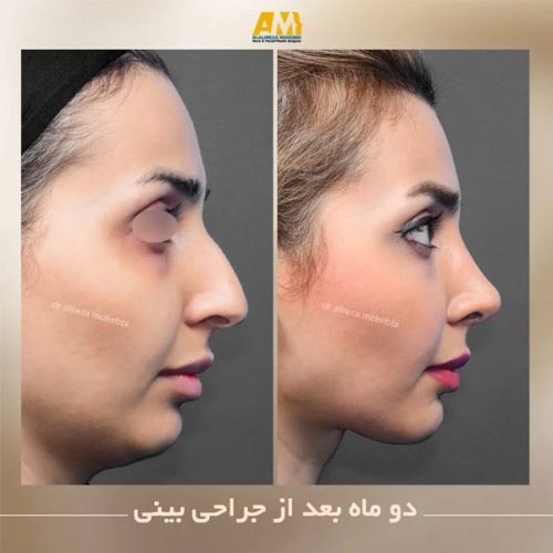 Rhinoplasty-74