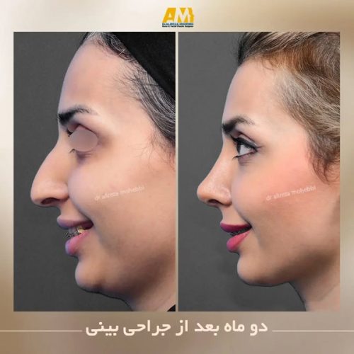 Rhinoplasty-75