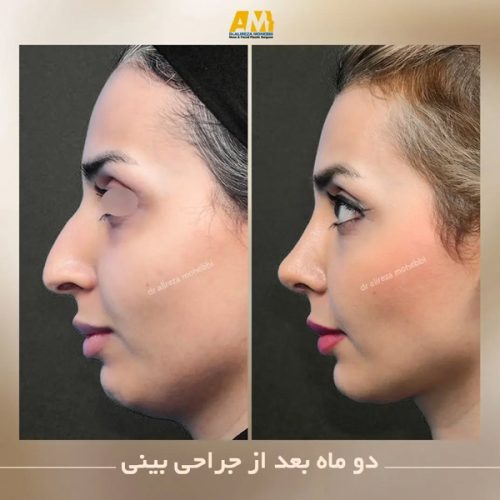 Rhinoplasty-77