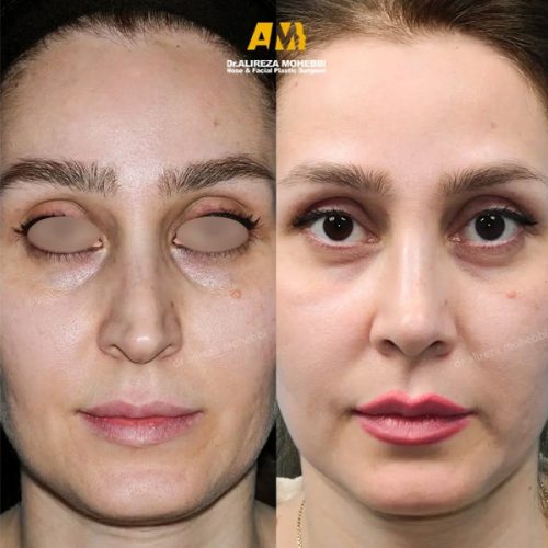 Rhinoplasty-79