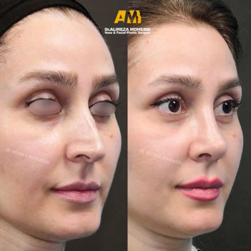 Rhinoplasty-80