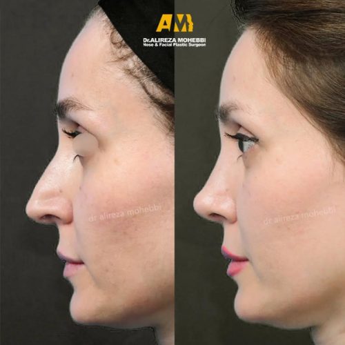 Rhinoplasty-84