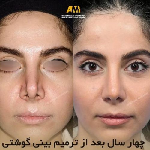 Rhinoplasty-86