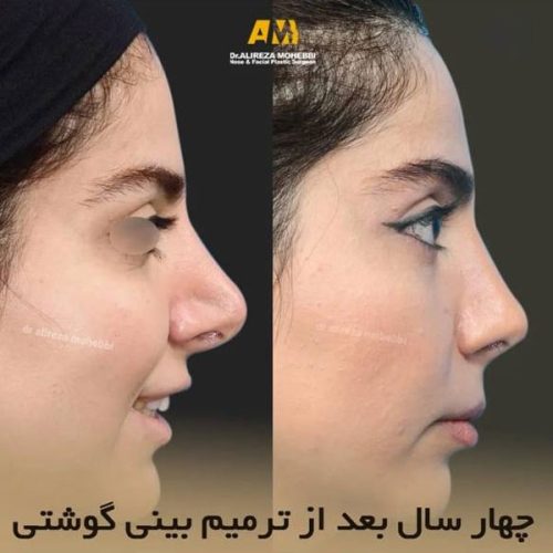 Rhinoplasty-88