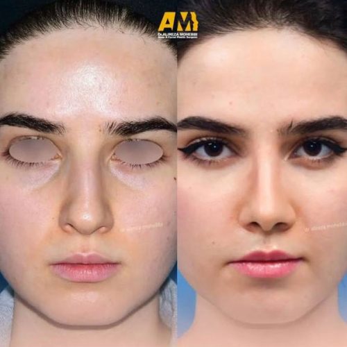 Rhinoplasty-90