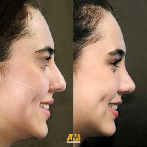 Rhinoplasty-99