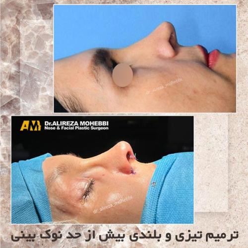 جراحی-بینی-31