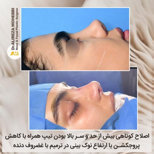جراحی-بینی-33