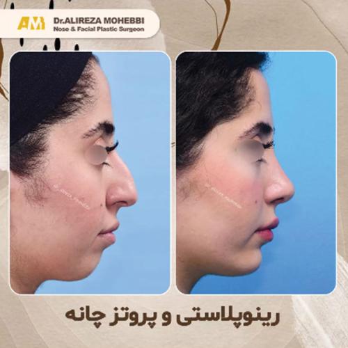 جراحی-بینی-35
