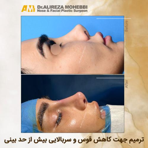 جراحی-بینی-36