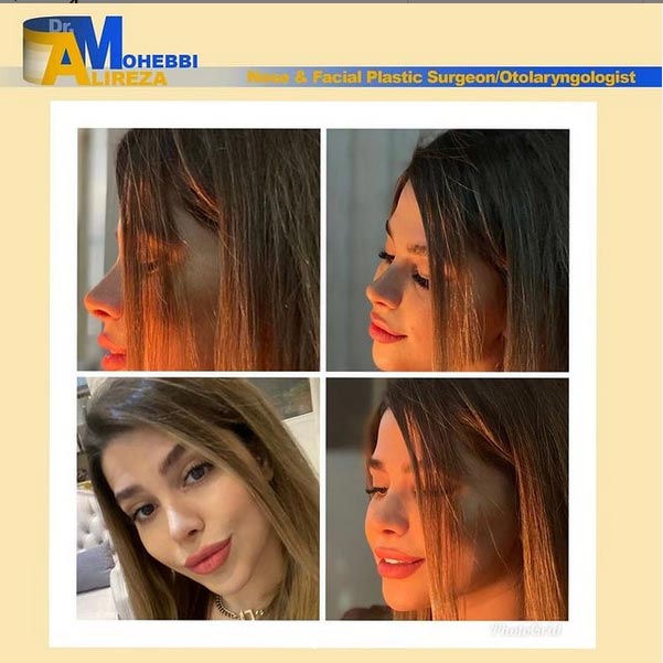 جراحی بینی - دکتر محبی