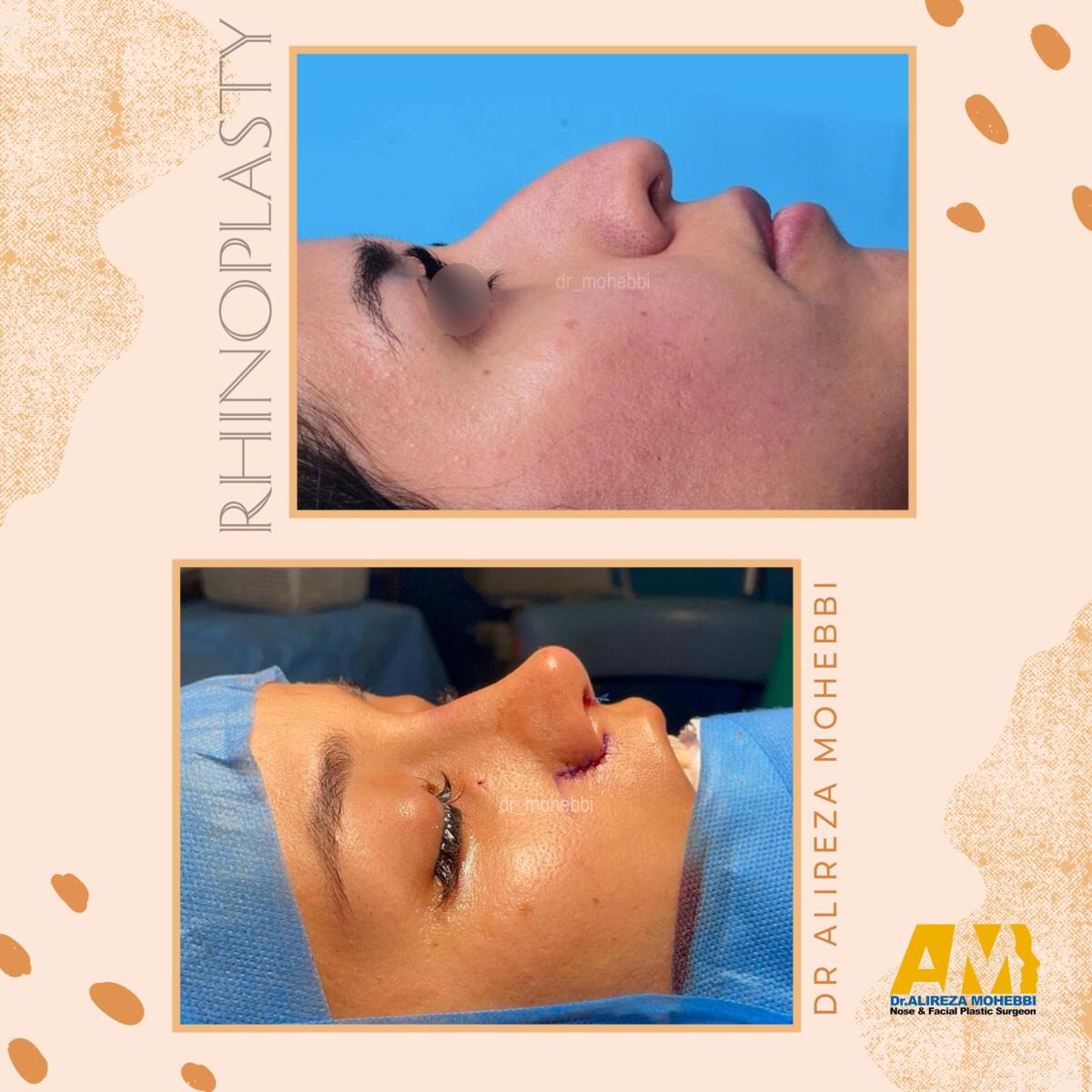 جراحی بینی - دکتر محبی