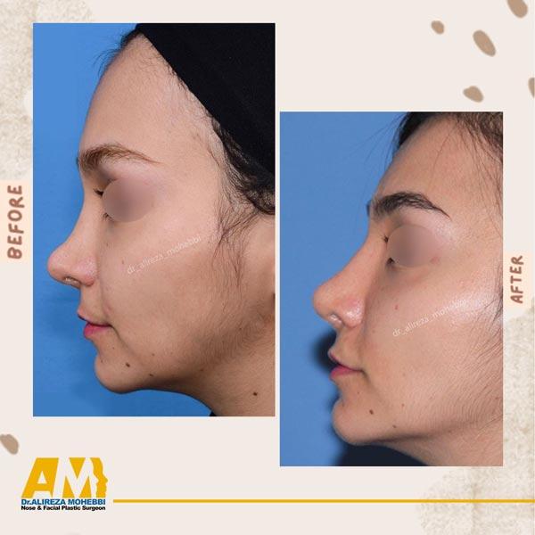جراحی بینی - دکتر محبی