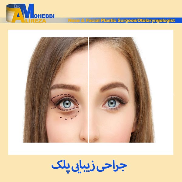 جراحی زیبایی پلک - دکتر محبی