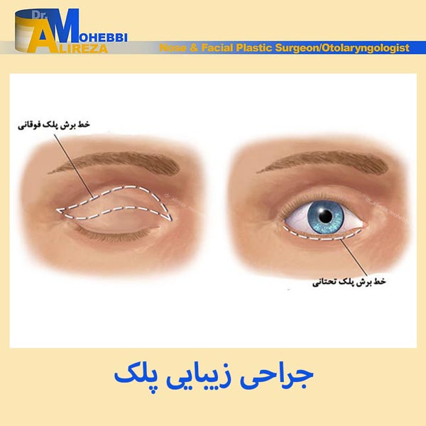 جراحی پلک - دکتر محبی