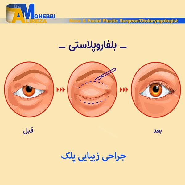 جراحی زیبایی پلک - دکتر محبی