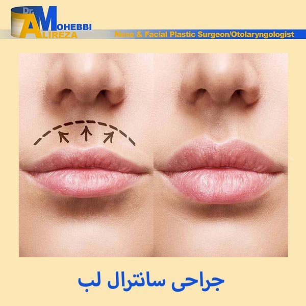 جراحی سانترال لب