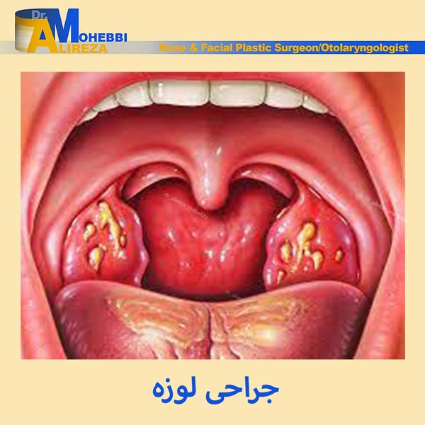 جراحی لوزه - دکتر محبی