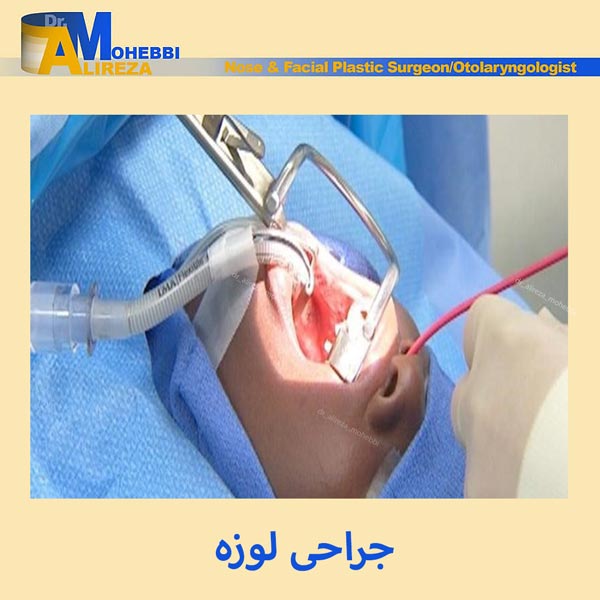 جراحی لوزه در تهران - دکتر محبی