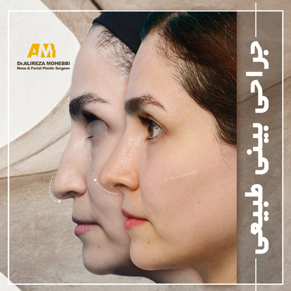 جراحی بینی طبیعی - دکتر محبی 