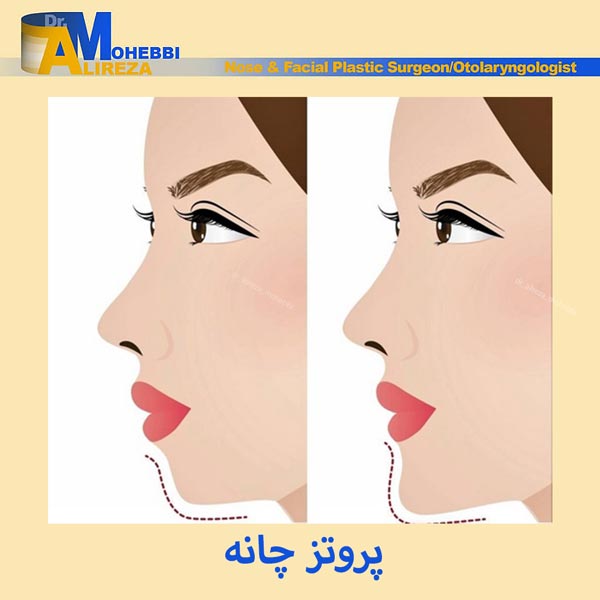 پروتز چانه در تهران - دکتر علیرضا محبی