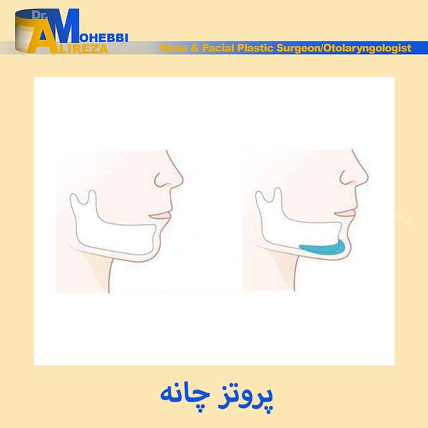 پروتز چانه در تهران - دکتر محبی