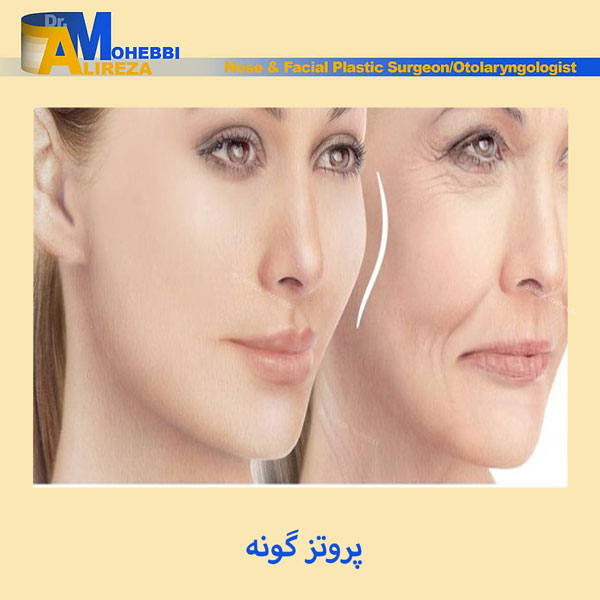 پروتز گونه - دکتر محبی